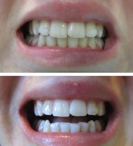 Sales Snow Teeth Whitening - The Facts