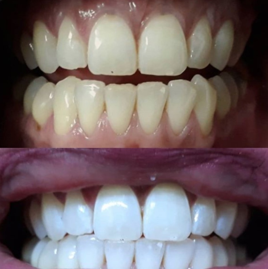 Snow Teeth Whitening Before and After Teeth Results